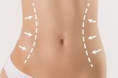 Vücut şekillendirmesinde liposuction