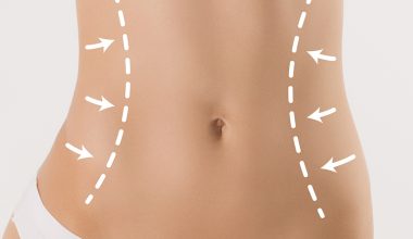 Vücut şekillendirmesinde liposuction
